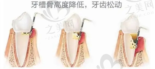 牙槽骨量不足导致牙齿松动