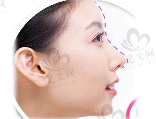 韩国清潭星MeTop整形外科鼻整形手术