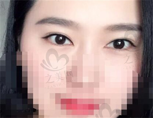郑州郑东美眼医疗美容双眼皮做的好吗？