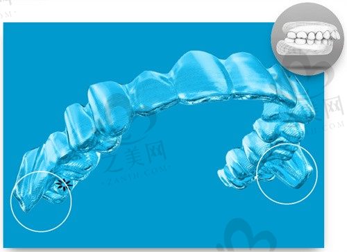 隐适美要戴多少副牙套才有变化?解答多少副属于困难病例