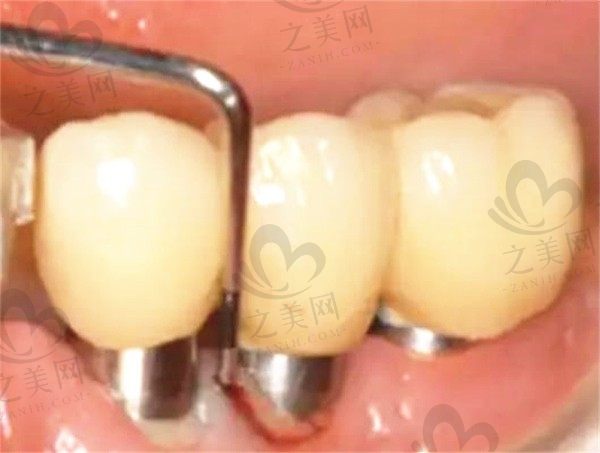 种植牙周围炎是怎样造成的?该怎么治疗比较好一点?