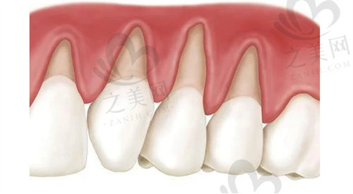 牙龈萎缩的表现是牙根暴露