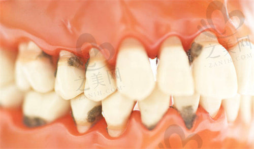 牙周疾病会引发牙齿脱落