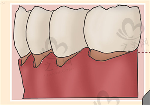 牙龈萎缩伴随红肿疼痛