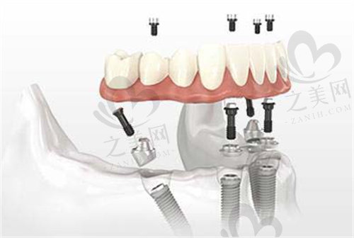 all-on-4种植牙图解