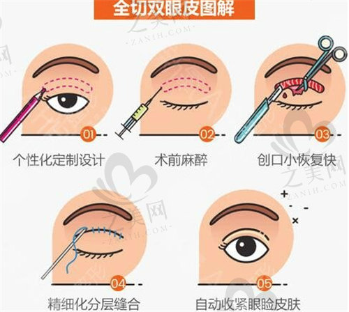 姜涛医生做双眼皮技术蛮好的