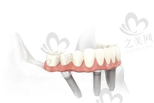 种植牙选allon4和allon6哪个好?从两者优缺点见分晓