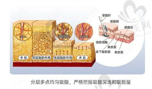 厦门欧菲吸脂怎么样?闪瘦3.0超S空间黄金超脂塑吸脂技术详解