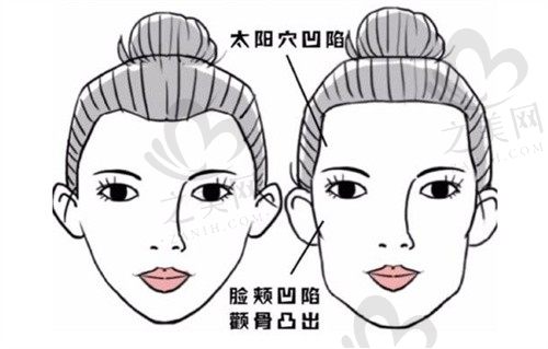 戴牙套一年脸型的变化大吗?牙套脸出现在第几个月?怎么恢复