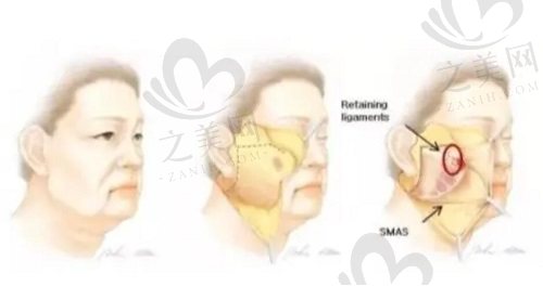 柳民熙3D童颜术