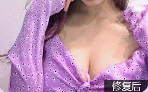 福州海峡林沸腾隆胸怎么样?“沸腾沟”丰胸术早已火出圈