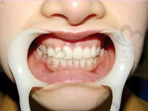 缺失牙齿歪斜修复方式