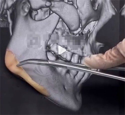 成都东篱磨骨医生叶斌资历过人,长曲线下颌角带祛外板咬肌3.8w起！