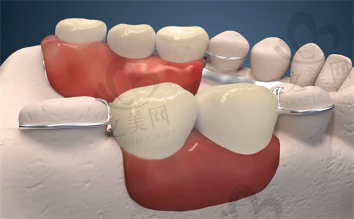 活动假牙分为牙冠、连接体、基托