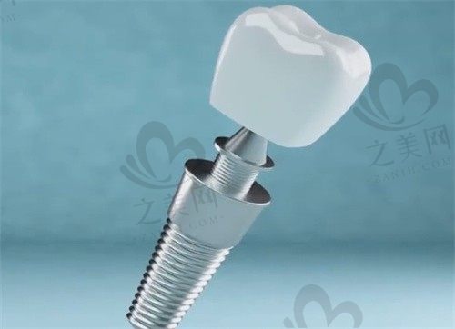 老人全口牙什么材质好?医生:活动假牙选树脂、种植牙选纯钛