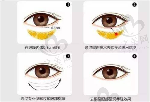 郑州美诗沁眼部整形行业翘楚，李东亮不开刀祛眼袋6800起