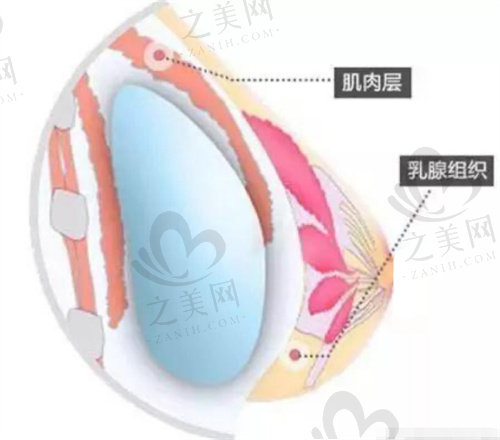 罗盛康2C双平面丰胸