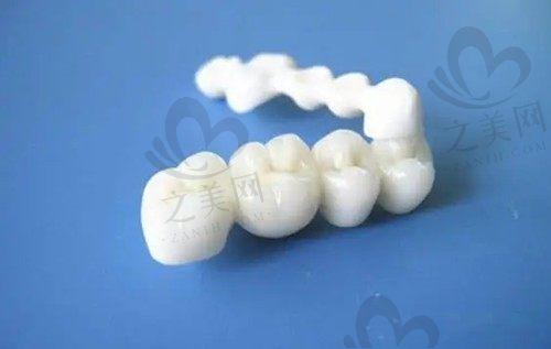 1000元的种植牙可靠吗?看看种植牙常用的品牌和价格