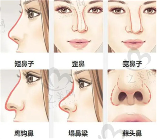 各种鼻部形态