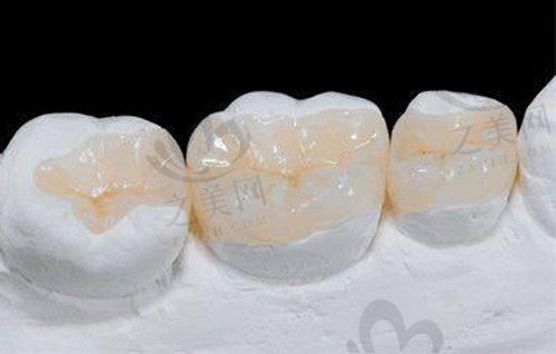 牙齿嵌体和牙冠哪个好?