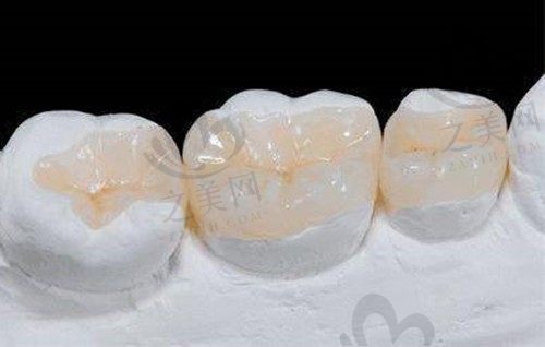 牙齿嵌体和牙冠哪个好?看看牙齿嵌体和牙冠的优缺点