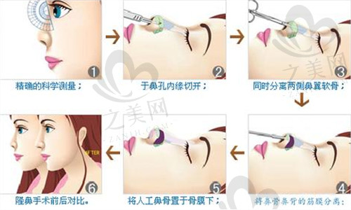 鼻综合手术流程