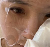 光子嫩肤