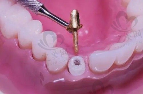 做牙冠打桩好还是不打桩好?打桩和不打桩有啥区别?