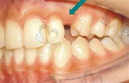 未萌出的牙齿会导致牙缝过大