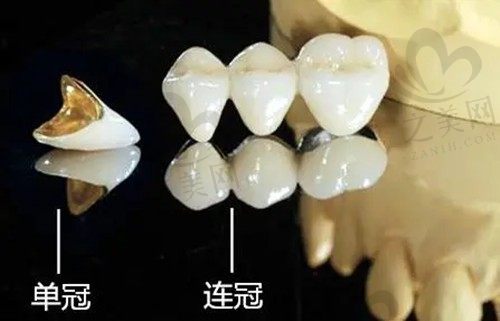 为什么医生喜欢做连冠牙?牙冠连冠好还是每颗分开好?