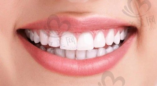 怎么判断全瓷牙安装不好?全瓷牙不密合有什么症状