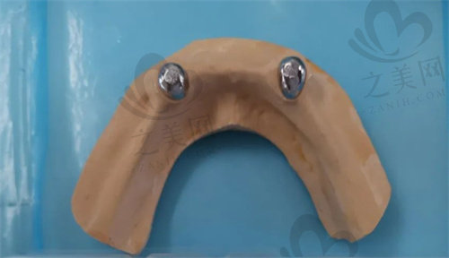 磁性附着体的衔铁部分（装在牙颌上）