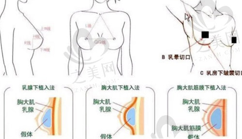 南京美贝尔黄名斗隆胸方法选择