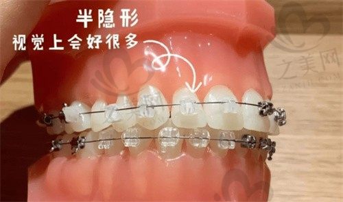 解析:美国3m金属自锁托槽和国产托槽的区别,附价格对比