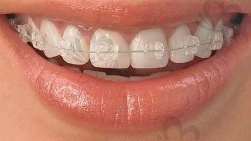 3000块可以矫正牙齿吗?便宜的牙齿矫正器有用吗?