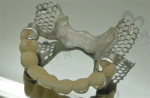 纯钛牙齿多少钱一颗?详解各类纯钛假牙优缺点,和全瓷牙谁好