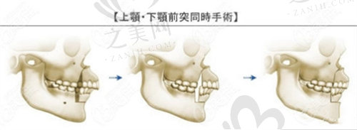 正颌手术的过程