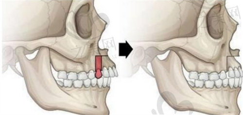 正颌手术的切口部位
