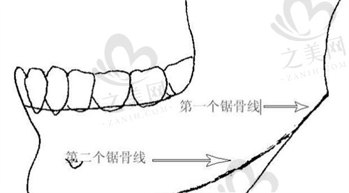 下颌角手术多久可以正常吃饭