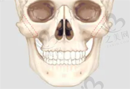 李志海医生能做的面部轮廓整形手术有哪些