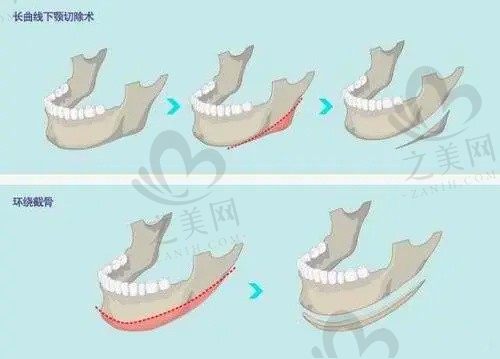 谁找李志海医生做过磨骨手术?李志海做颧骨内推实例多多口碑好