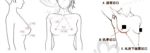 胸部数据和切口位置