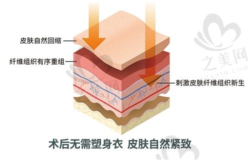 深圳曹孟君土麦森吸脂术后无需塑身衣