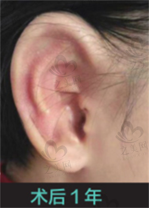 郭树忠可接诊耳再造一期、二期、三期手术