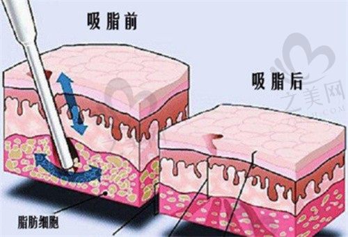 张荣明和李相旭吸脂技术谁更牛?附技术特色+顾客口碑对比