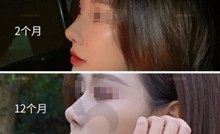 深度测评杜轶男做鼻子为什么贵,看看杜轶男医生做鼻子做得好吗