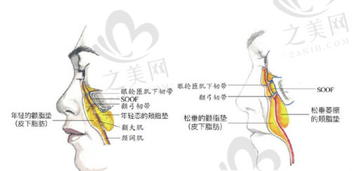 广州黄广香SMAS拉皮除皱术