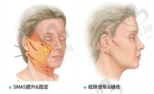 广州黄广香拉皮手术做得怎么样?小切口除皱术成效好价格还不贵