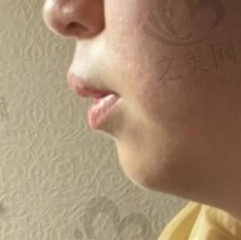 上海治疗下巴后缩嘴凸的医生医院,附上海下巴后缩矫正手术价格