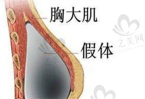 南京隆胸的医生哪个好?夏建军/沈正宇/吴国平医生隆胸实力出众